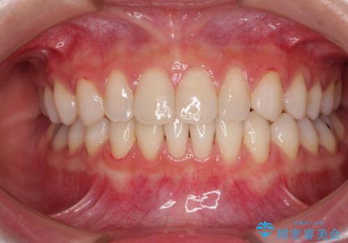 隙間の多い歯並びをインビザラインで矯正治療