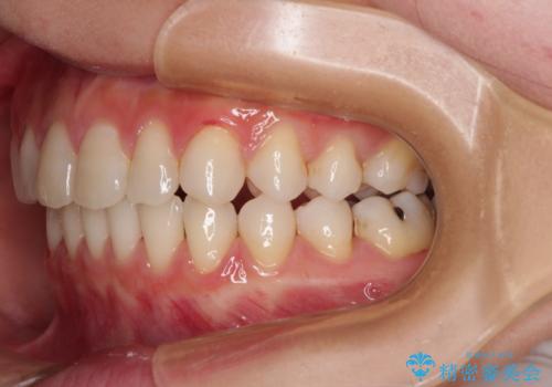 隙間の多い歯並びをインビザラインで矯正治療の治療後
