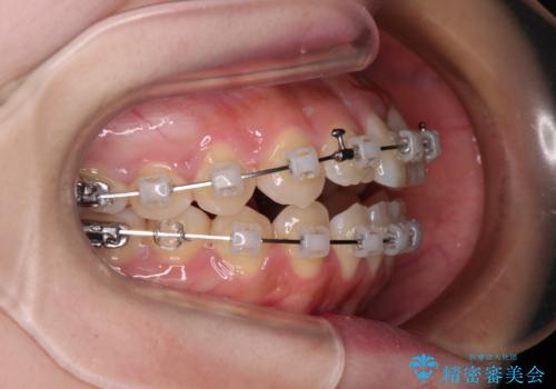 隙間が空いてデコボコした前歯を治したい　ワイヤー装置による矯正治療の治療中