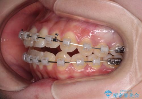 隙間が空いてデコボコした前歯を治したい ワイヤー装置による矯正治療の治療中