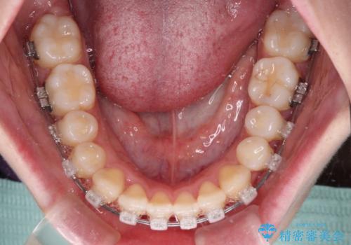 隙間が空いてデコボコした前歯を治したい ワイヤー装置による矯正治療の治療中