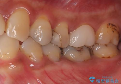 【根管治療・オールセラミッククラウン】何もしなくても歯が痛い 咬むと更に痛いの治療前