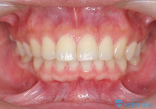 カリエール・マイクロインプラントを併用した歯の突出を改善する大きな遠心移動の症例 治療前