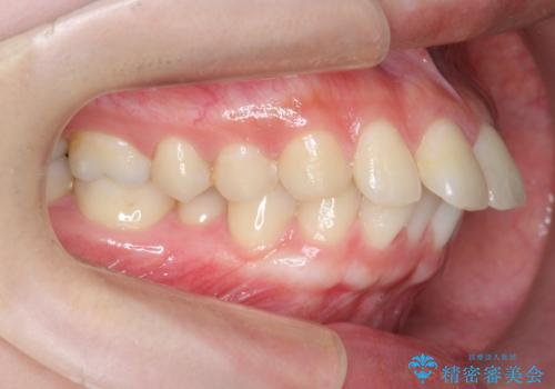 カリエール・マイクロインプラントを併用した歯の突出を改善する大きな遠心移動の治療前