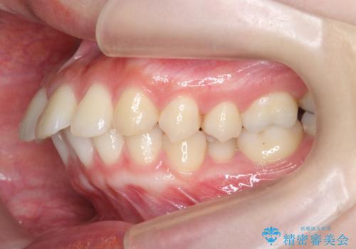 カリエール・マイクロインプラントを併用した歯の突出を改善する大きな遠心移動の治療前