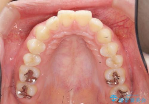 カリエール・マイクロインプラントを併用した歯の突出を改善する大きな遠心移動の治療前