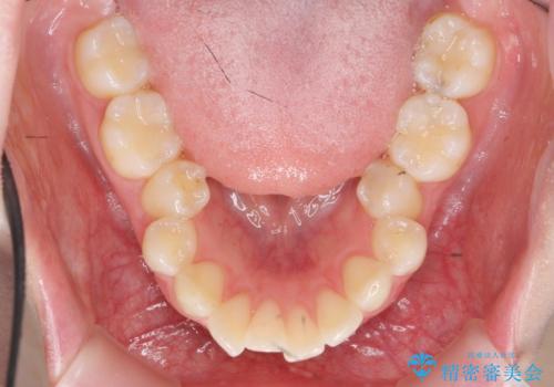 カリエール・マイクロインプラントを併用した歯の突出を改善する大きな遠心移動の治療前