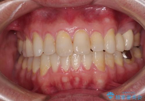 内側に転位した歯とボロボロのむし歯　インビザラインによる矯正治療とむし歯治療の治療後
