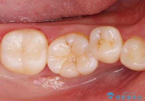 [セラミックインレー] 黒くなった歯の溝を白くしたいの症例 治療後
