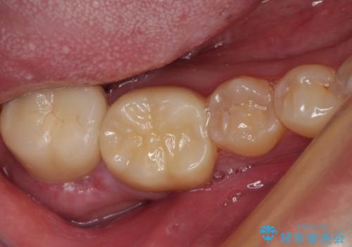 海外赴任前に間に合わせたい　内部でむし歯が進行した奥歯の補綴治療の治療後