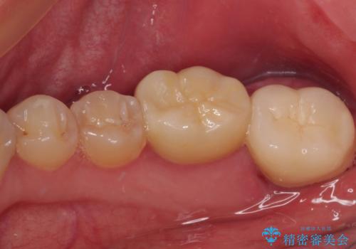 海外赴任前に間に合わせたい 内部でむし歯が進行した奥歯の補綴治療の治療後
