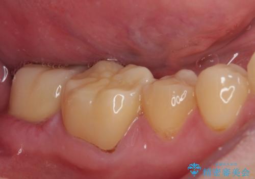 海外赴任前に間に合わせたい 内部でむし歯が進行した奥歯の補綴治療の治療後