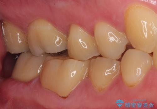 海外赴任前に間に合わせたい 内部でむし歯が進行した奥歯の補綴治療の治療後