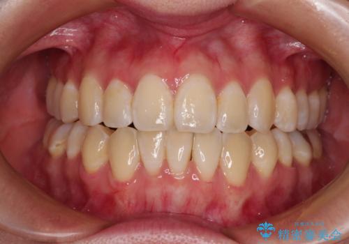 外に飛び出して磨きにくい奥歯と上下前歯の隙間　インビザラインによる矯正治療の症例 治療後
