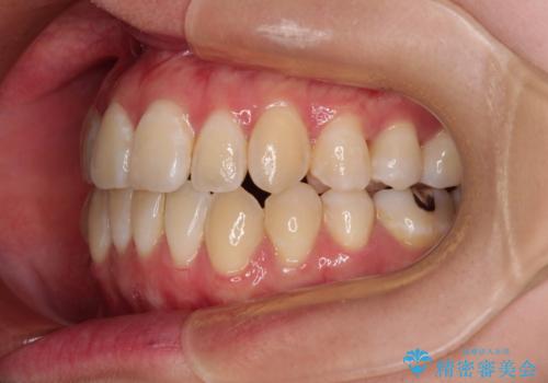 外に飛び出して磨きにくい奥歯と上下前歯の隙間　インビザラインによる矯正治療の治療後