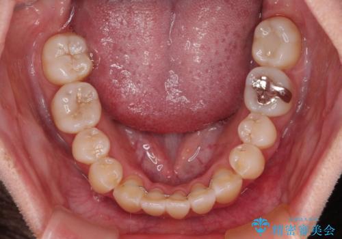 外に飛び出して磨きにくい奥歯と上下前歯の隙間　インビザラインによる矯正治療の治療後