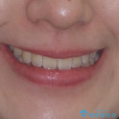 外に飛び出して磨きにくい奥歯と上下前歯の隙間　インビザラインによる矯正治療の治療後（顔貌）
