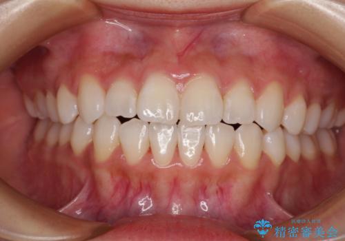 隙間が空いてデコボコした前歯を治したい ワイヤー装置による矯正治療の症例 治療後