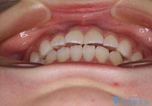 隙間が空いてデコボコした前歯を治したい ワイヤー装置による矯正治療の治療後