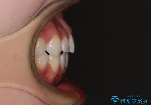 隙間が空いてデコボコした前歯を治したい ワイヤー装置による矯正治療の治療後