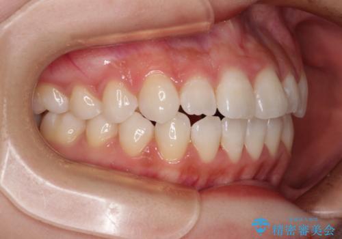 隙間が空いてデコボコした前歯を治したい ワイヤー装置による矯正治療の治療後