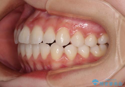 隙間が空いてデコボコした前歯を治したい ワイヤー装置による矯正治療の治療後