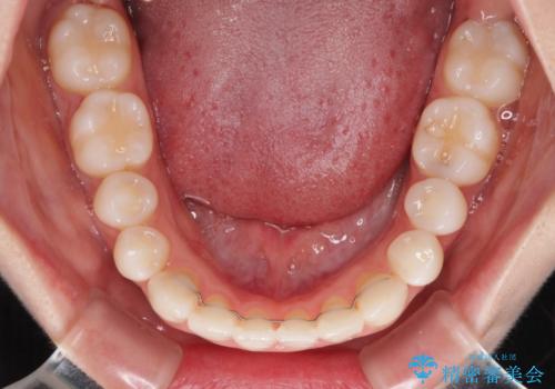 隙間が空いてデコボコした前歯を治したい ワイヤー装置による矯正治療の治療後