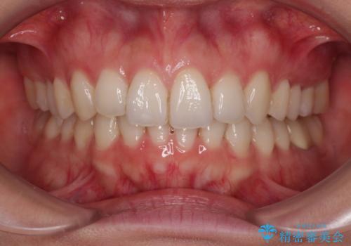 矯正治療の後戻り インビザライン・ライトでの再矯正の症例 治療後