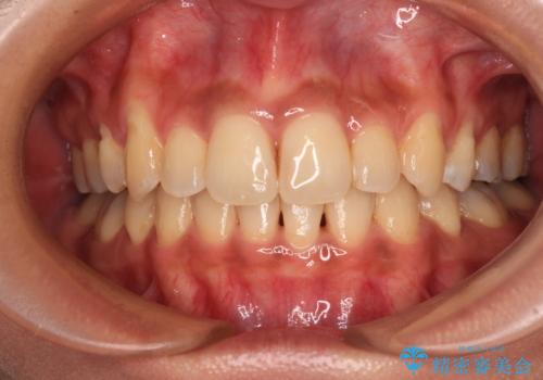 八重歯と出っ歯を治したい ワイヤー装置での抜歯矯正の症例 治療後