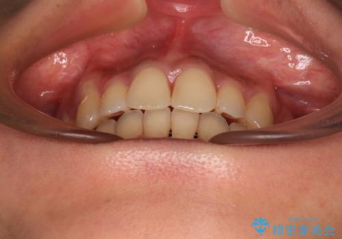 八重歯と出っ歯を治したい ワイヤー装置での抜歯矯正の治療後