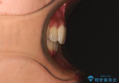 八重歯と出っ歯を治したい ワイヤー装置での抜歯矯正の治療後