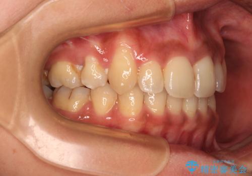 八重歯と出っ歯を治したい　ワイヤー装置での抜歯矯正の治療後