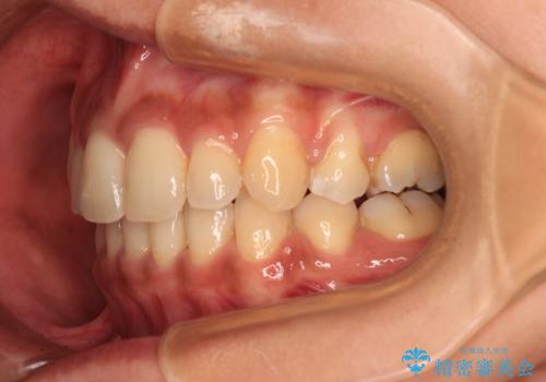 八重歯と出っ歯を治したい ワイヤー装置での抜歯矯正の治療後