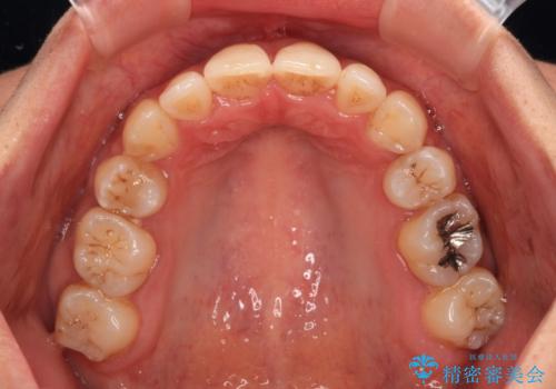 八重歯と出っ歯を治したい　ワイヤー装置での抜歯矯正の治療後