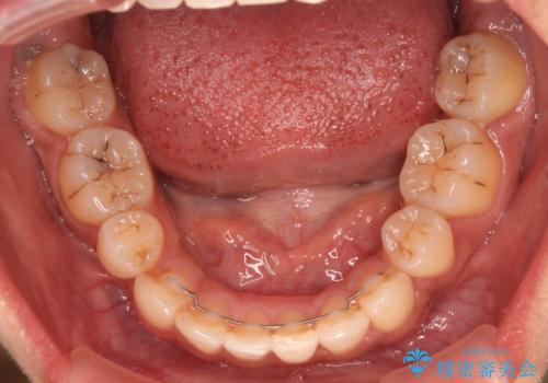 八重歯と出っ歯を治したい ワイヤー装置での抜歯矯正の治療後