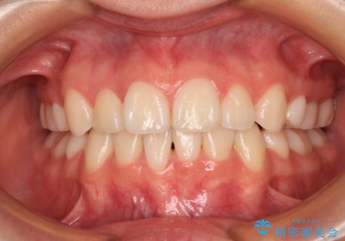 前歯のデコボコとクロスバイトを治したい ワイヤー装置による抜歯矯正の症例 治療後