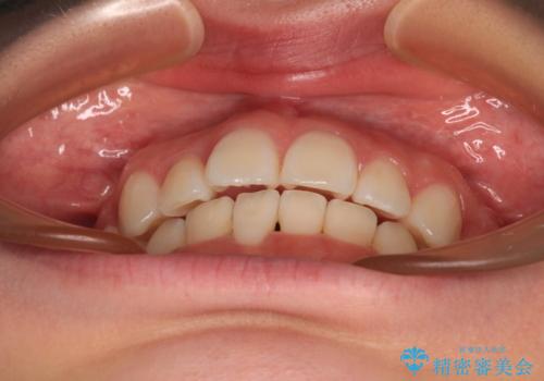 前歯のデコボコとクロスバイトを治したい ワイヤー装置による抜歯矯正の治療後