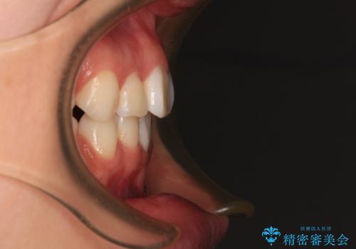 前歯のデコボコとクロスバイトを治したい ワイヤー装置による抜歯矯正の治療後