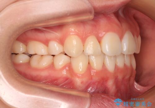 前歯のデコボコとクロスバイトを治したい　ワイヤー装置による抜歯矯正の治療後