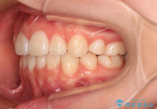 前歯のデコボコとクロスバイトを治したい　ワイヤー装置による抜歯矯正の治療後