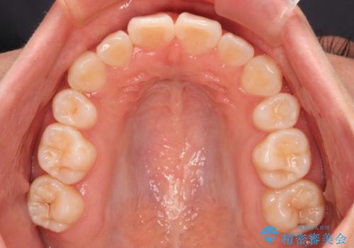 前歯のデコボコとクロスバイトを治したい ワイヤー装置による抜歯矯正の治療後