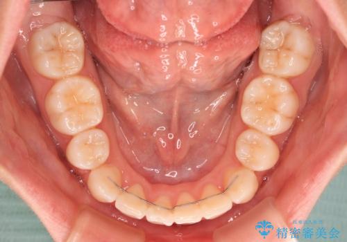 前歯のデコボコとクロスバイトを治したい ワイヤー装置による抜歯矯正の治療後