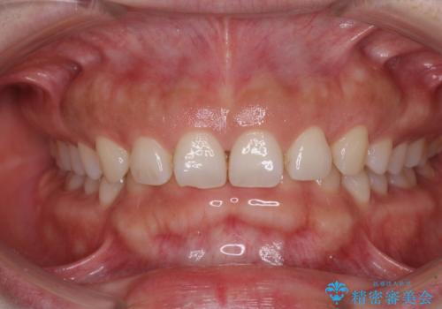 【モニター】ディープバイトを治す ワイヤー装置による矯正治療の症例 治療前