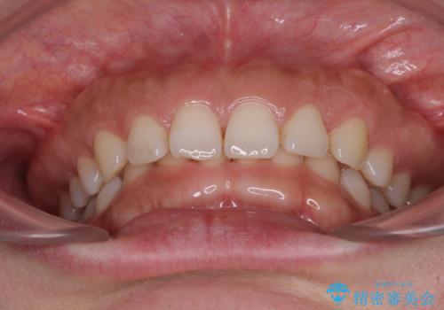 【モニター】ディープバイトを治す ワイヤー装置による矯正治療の治療前