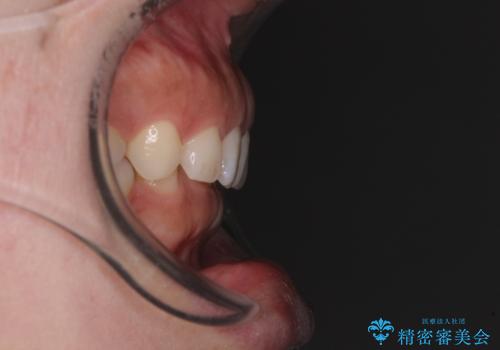 【モニター】ディープバイトを治す ワイヤー装置による矯正治療の治療前