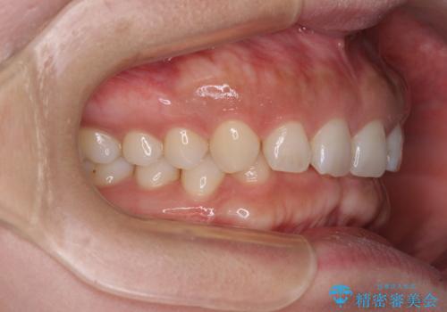 【モニター】ディープバイトを治す ワイヤー装置による矯正治療の治療前