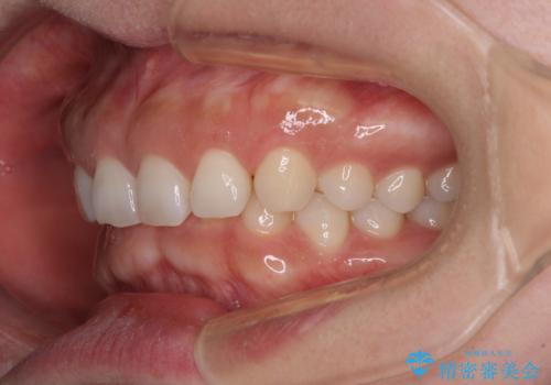 【モニター】ディープバイトを治す ワイヤー装置による矯正治療の治療前