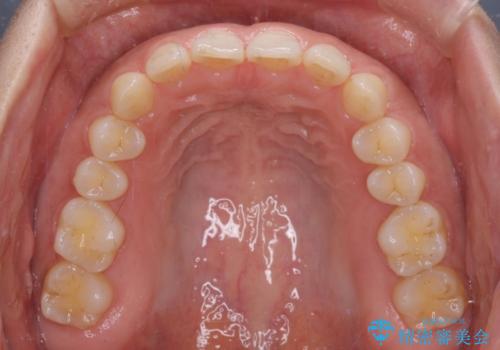 【モニター】ディープバイトを治す ワイヤー装置による矯正治療の治療前