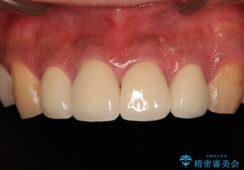 目立つ金属をすべてセラミックに 全顎的メタルフリー治療の治療後