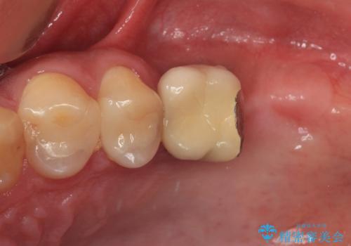 目立つ金属をすべてセラミックに 全顎的メタルフリー治療の治療後